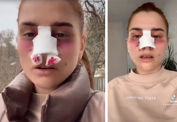 Cô gái chia sẻ hình ảnh trước và sau khi sửa mũi thu hút 13 triệu lượt xem vì lột xác ảo diệu, tưởng được khen xinh hoá ra gây tranh cãi lớn-2