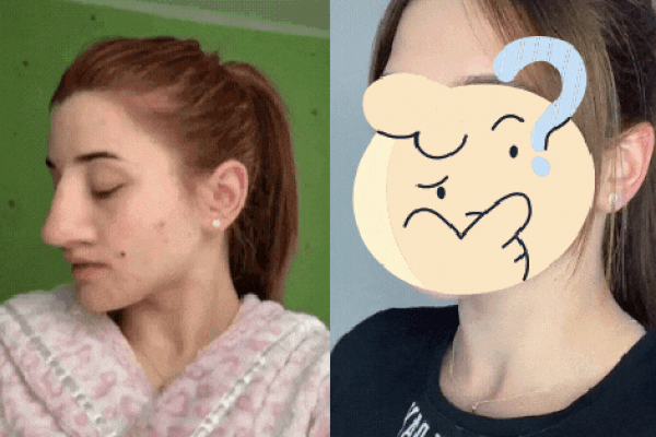 Cô gái chia sẻ hình ảnh trước và sau khi sửa mũi thu hút 13 triệu lượt xem vì lột xác ảo diệu, tưởng được khen xinh hoá ra gây tranh cãi lớn