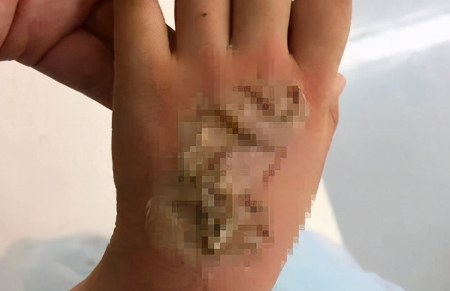 Nghe tiếng nổ lớn từ phòng ngủ, bà hoảng hồn phát hiện tay cháu gái bị nướng chín bởi thiết bị thông minh nhiều phụ huynh vẫn mua cho con-2