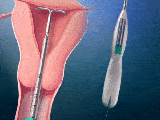 Phương pháp tránh thai mà người giám hộ ép Britney Spears phải dùng, không cho cô sinh thêm con là gì?-5