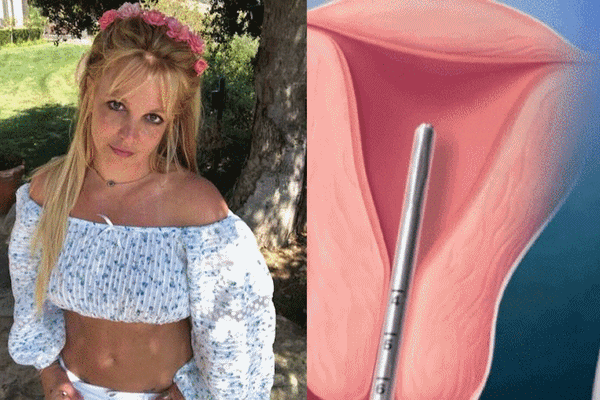 Phương pháp tránh thai mà người giám hộ ép Britney Spears phải dùng, không cho cô sinh thêm con là gì?