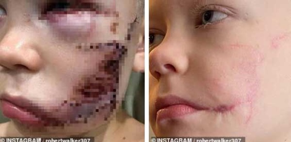 Phải khâu 90 mũi vì xả thân cứu em gái khỏi chó dữ, cậu bé được thế giới phong người hùng” và khuôn mặt hiện tại gây xúc động mạnh-6