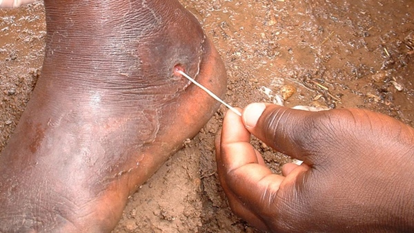 Bí ẩn đằng sau con rắn trong chân người mà Hoa Đà phát hiện cách đây 2000 năm, giúp y học ngày nay giải mã loại bệnh này-3