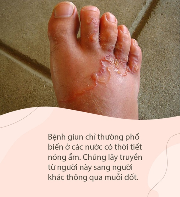 Bí ẩn đằng sau con rắn trong chân người mà Hoa Đà phát hiện cách đây 2000 năm, giúp y học ngày nay giải mã loại bệnh này-4