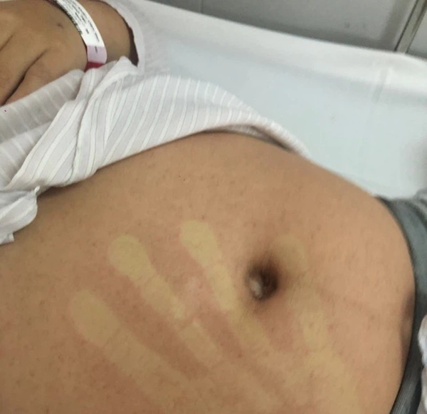 Hà Nội: Tưởng sốt sau tiêm vaccine Covid-19, không ngờ mắc sốt xuất huyết-2