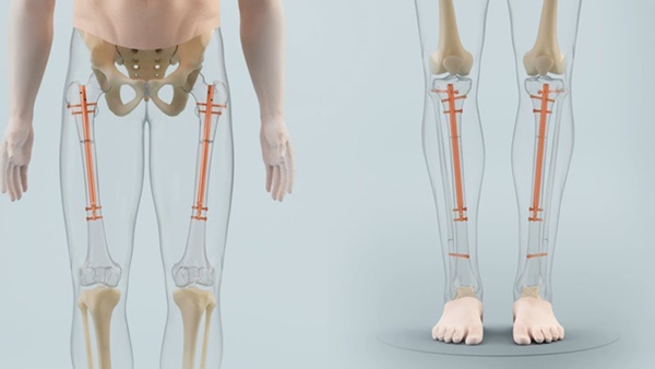 Đập xương kéo chân: Phương pháp phẫu thuật thẩm mỹ kinh dị đột nhiên thành hot trend ở Ấn Độ và hậu quả kinh hoàng phía sau-2
