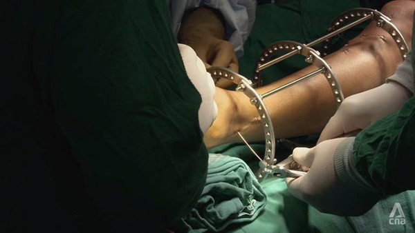 Đập xương kéo chân: Phương pháp phẫu thuật thẩm mỹ kinh dị đột nhiên thành hot trend ở Ấn Độ và hậu quả kinh hoàng phía sau-1