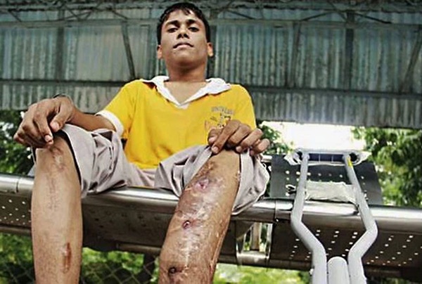 Đập xương kéo chân: Phương pháp phẫu thuật thẩm mỹ kinh dị đột nhiên thành hot trend ở Ấn Độ và hậu quả kinh hoàng phía sau-5