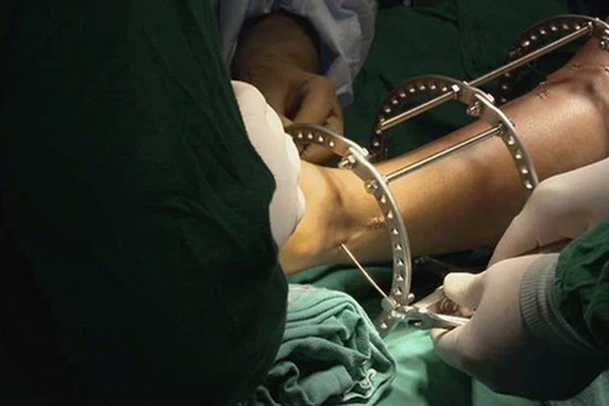 Đập xương kéo chân: Phương pháp phẫu thuật thẩm mỹ kinh dị đột nhiên thành 