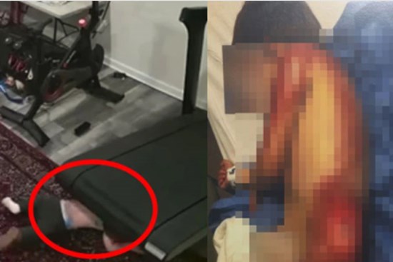 Bố mẹ để con nhỏ nghịch máy chạy bộ khiến đứa trẻ bị 