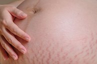 Không phải ai cũng bị rạn da khi mang bầu, nhưng 4 kiểu phụ nữ này cần đặc biệt chú ý