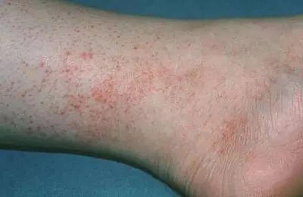 Cô gái 28 tuổi mắc bệnh về máu, những dấu hiệu cảnh báo đã xuất hiện trước đó nhưng lại bị bỏ qua-2