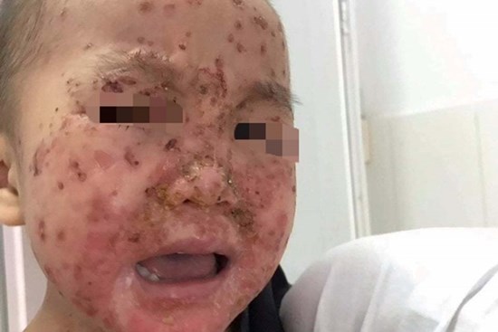 Bé trai toàn thân chốc lở, mưng mủ, đóng vẩy do thói quen triệu bà mẹ vẫn làm mỗi ngày