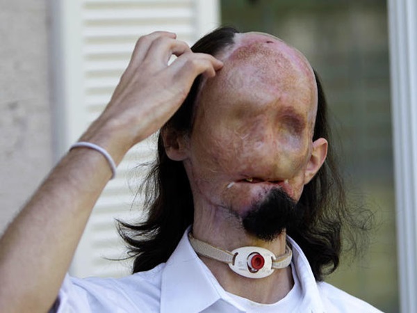 Từng bị vợ bỏ vì quá xấu xí, người đàn ông dị dạng không mặt” gây bất ngờ với cuộc sống và diện mạo hiện tại sau phẫu thuật-2