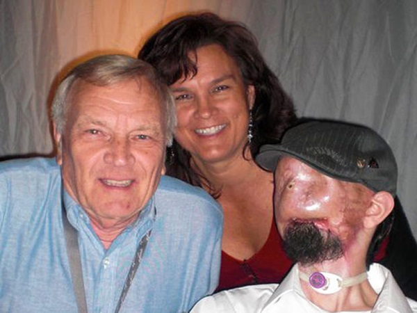 Từng bị vợ bỏ vì quá xấu xí, người đàn ông dị dạng không mặt” gây bất ngờ với cuộc sống và diện mạo hiện tại sau phẫu thuật-3