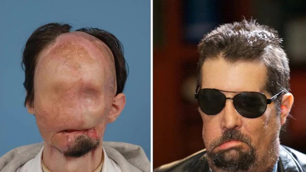 Từng bị vợ bỏ vì quá xấu xí, người đàn ông dị dạng không mặt” gây bất ngờ với cuộc sống và diện mạo hiện tại sau phẫu thuật-4