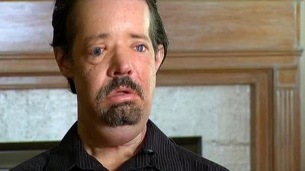 Từng bị vợ bỏ vì quá xấu xí, người đàn ông dị dạng không mặt” gây bất ngờ với cuộc sống và diện mạo hiện tại sau phẫu thuật-6