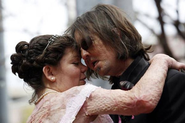 Từng bị vợ bỏ vì quá xấu xí, người đàn ông dị dạng không mặt” gây bất ngờ với cuộc sống và diện mạo hiện tại sau phẫu thuật-7