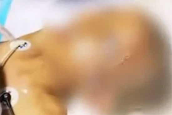 Đổ thuốc trừ sâu lên đầu để diệt chấy, mẹ khiến con gái 11 tuổi nhiễm độc nguy cấp phải nhập viện