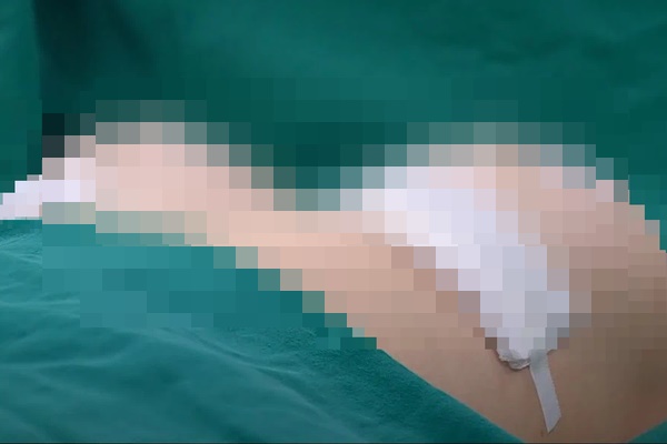 Tự tiêm hoá chất không rõ nguồn gốc để làm to ngực, cô gái trẻ nhập viện khẩn cấp-2