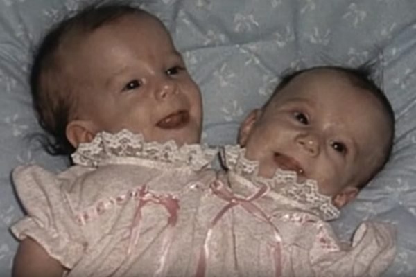 Bị chẩn đoán khó sống sót, cặp chị em sinh đôi dính liền chỉ có 2 chân khiến thế giới kinh ngạc với cuộc sống và diện mạo sau hơn 30 năm-1