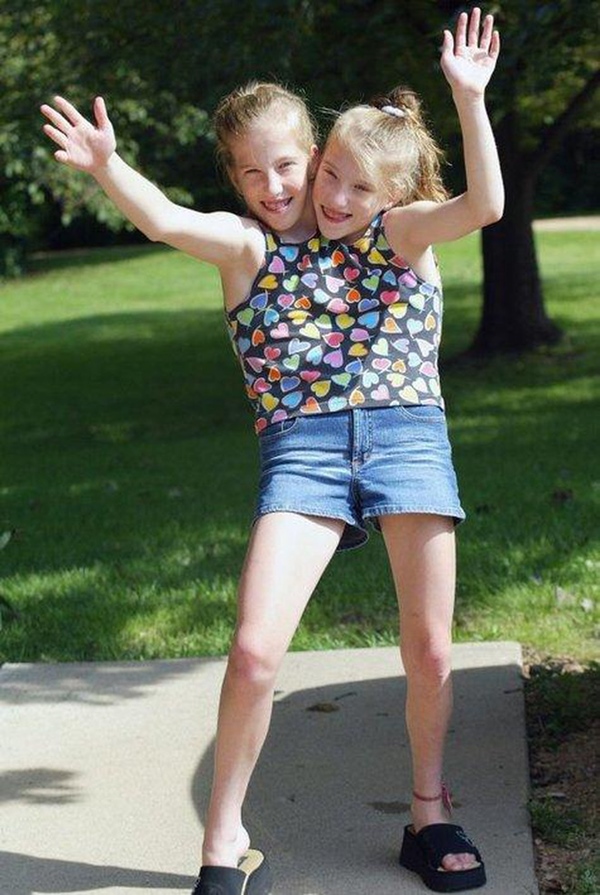 Bị chẩn đoán khó sống sót, cặp chị em sinh đôi dính liền chỉ có 2 chân khiến thế giới kinh ngạc với cuộc sống và diện mạo sau hơn 30 năm-3