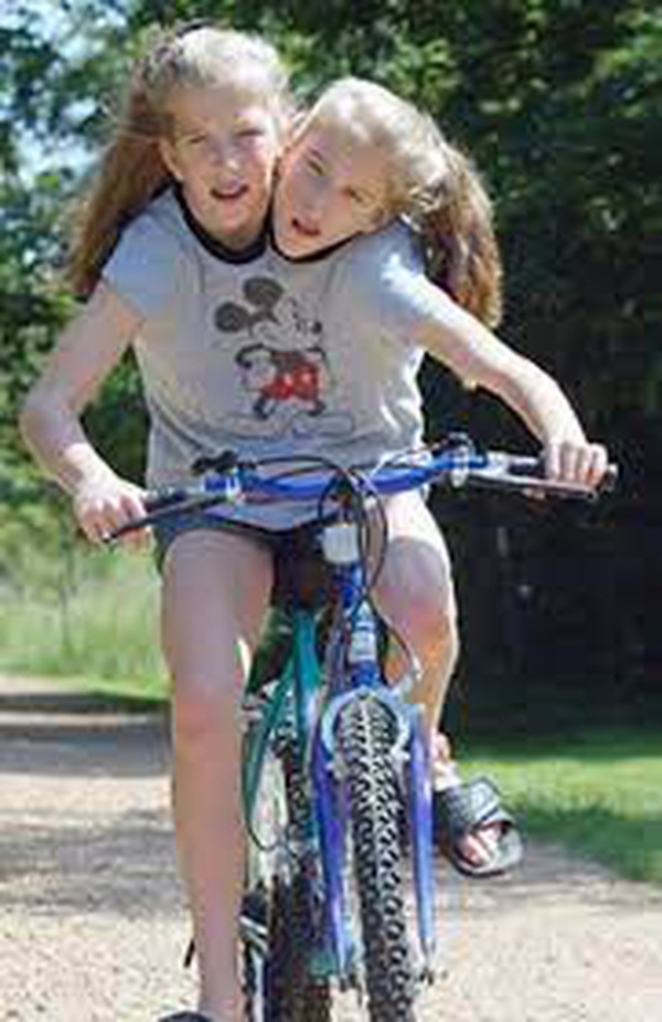 Bị chẩn đoán khó sống sót, cặp chị em sinh đôi dính liền chỉ có 2 chân khiến thế giới kinh ngạc với cuộc sống và diện mạo sau hơn 30 năm-4