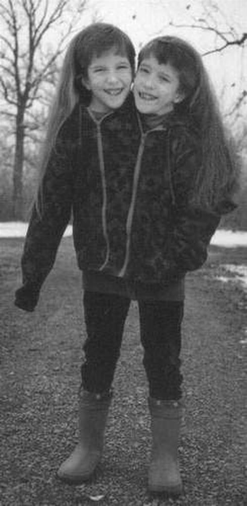 Bị chẩn đoán khó sống sót, cặp chị em sinh đôi dính liền chỉ có 2 chân khiến thế giới kinh ngạc với cuộc sống và diện mạo sau hơn 30 năm-5