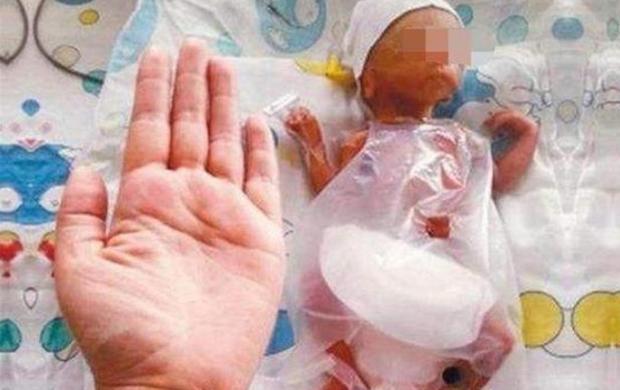 Em bé nhỏ nhất thế giới có chiều dài cơ thể chỉ bằng một cái bút, cuộc sống hiện tại khiến nhiều người bất ngờ!-2