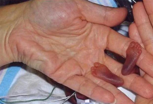 Em bé nhỏ nhất thế giới có chiều dài cơ thể chỉ bằng một cái bút, cuộc sống hiện tại khiến nhiều người bất ngờ!-4