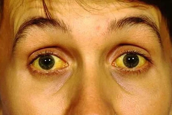 3 biểu hiện bất thường trên khuôn mặt cho thấy bạn đang có nguy cơ mắc ung thư gan-1