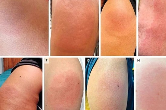 2 kiểu phản ứng phụ sau khi tiêm vắc xin: Phản ứng cấp tính cần xử lý ngay, phản ứng muộn cần theo dõi