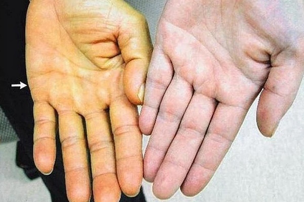 4 biểu hiện bất thường trên da là dấu hiệu sớm của bệnh ung thư gan, cần chủ động đi khám ngay khi gặp phải-1