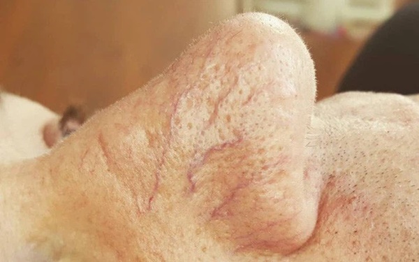 4 biểu hiện bất thường trên da là dấu hiệu sớm của bệnh ung thư gan, cần chủ động đi khám ngay khi gặp phải-2