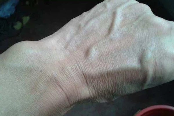 Người gan kém thường có 3 thay đổi bất thường ở bàn tay, đi khám ngay vì rất dễ là dấu hiệu của ung thư gan-1