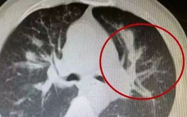 Người đàn ông phổi nhiễm nấm thối rữa như bông gòn, suýt mất mạng vì thường xuyên uống thuốc kháng sinh bừa bãi-2