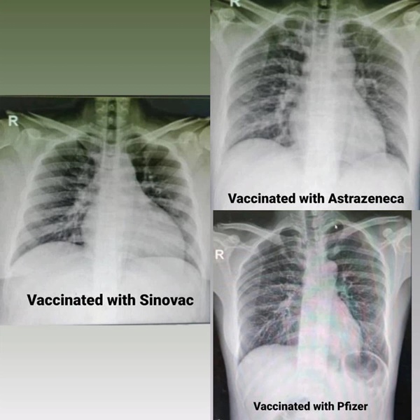 4 bức ảnh chụp phổi của bệnh nhân Covid-19 đã tiêm các loại vắc xin khác nhau và không tiêm: Kết quả gây sốc!-2