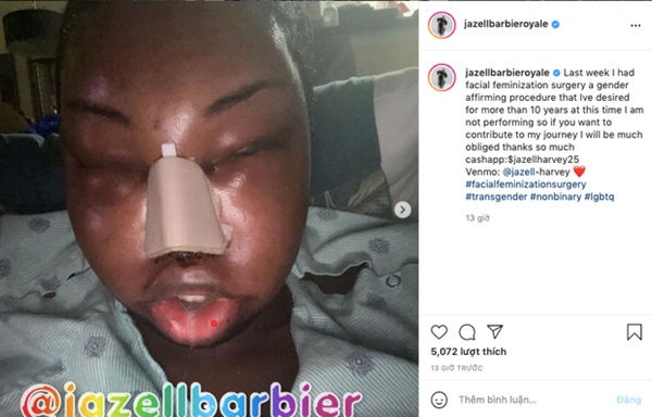 Sốc: Hoa hậu Chuyển giới Quốc tế kế nhiệm Hương Giang công khai đập mặt xây lại, nhan sắc biến dạng không nhận ra-1