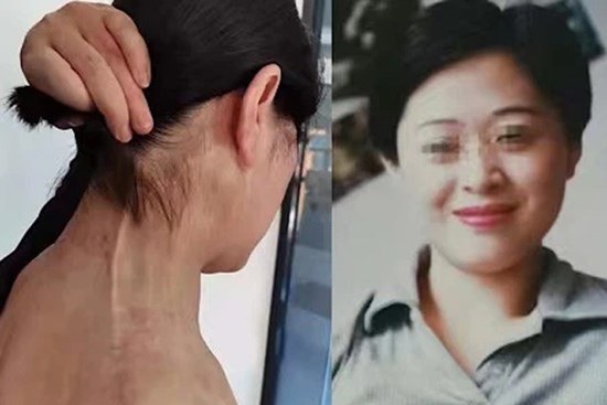 Bị bạn trai cũ cuồng ghen tạt axit và đeo bám suốt 12 năm trời, người phụ nữ suýt bị đâm kim tiêm chứa HIV vào người đã có màn 