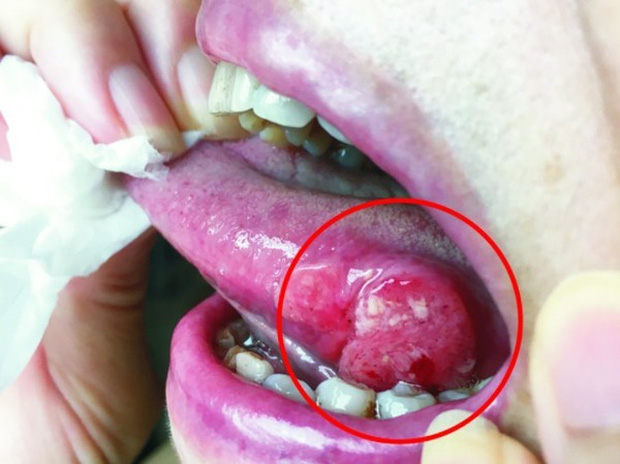 Người phụ nữ bị lở loét, đóng vảy trên lưỡi suốt 2 tháng, đi khám thì phát hiện mắc ung thư lưỡi-1