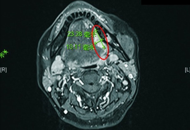 Người phụ nữ bị lở loét, đóng vảy trên lưỡi suốt 2 tháng, đi khám thì phát hiện mắc ung thư lưỡi-2