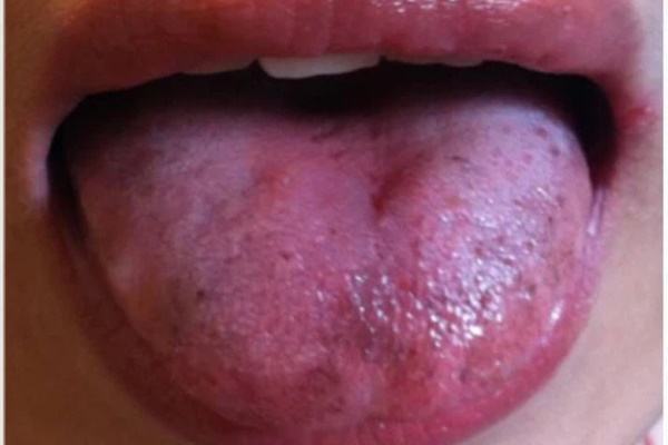 Tim bị bệnh thì lưỡi sẽ có 3 biểu hiện bất thường, nếu có dù chỉ một cái cũng nên đi khám ngay-1