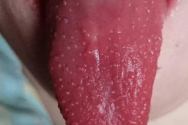 Tim bị bệnh thì lưỡi sẽ có 3 biểu hiện bất thường, nếu có dù chỉ một cái cũng nên đi khám ngay-2