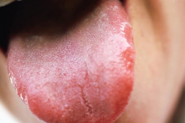 Tim bị bệnh thì lưỡi sẽ có 3 biểu hiện bất thường, nếu có dù chỉ một cái cũng nên đi khám ngay-3