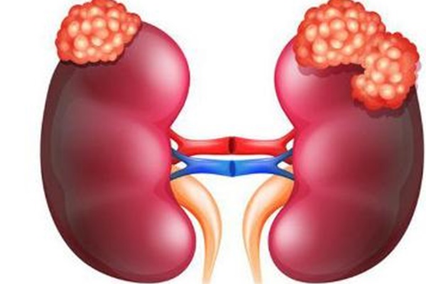 Cảnh báo ung thư thận, dấu hiệu cần lưu ý-1
