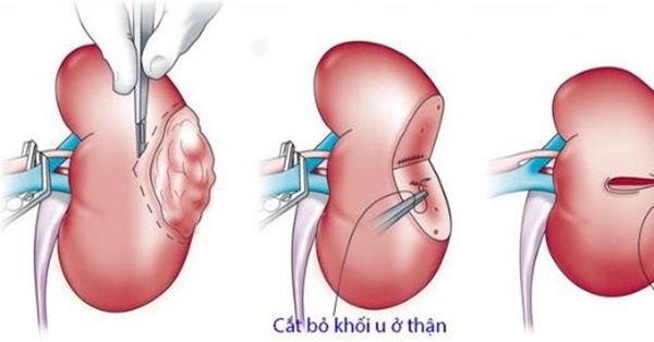 Cảnh báo ung thư thận, dấu hiệu cần lưu ý-3