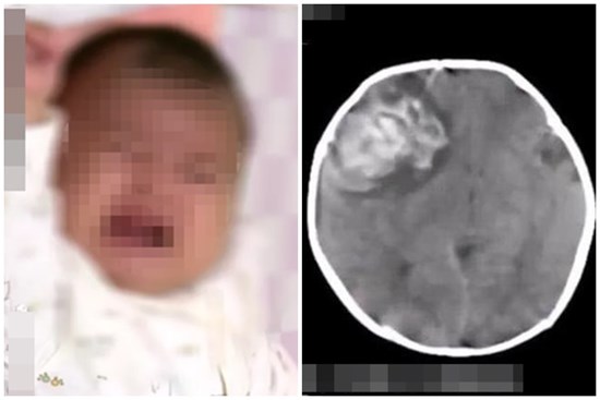 Bé sơ sinh 2 tháng tuổi bị xuất huyết não đột ngột chỉ vì thói quen ăn uống này của mẹ khi ở cữ