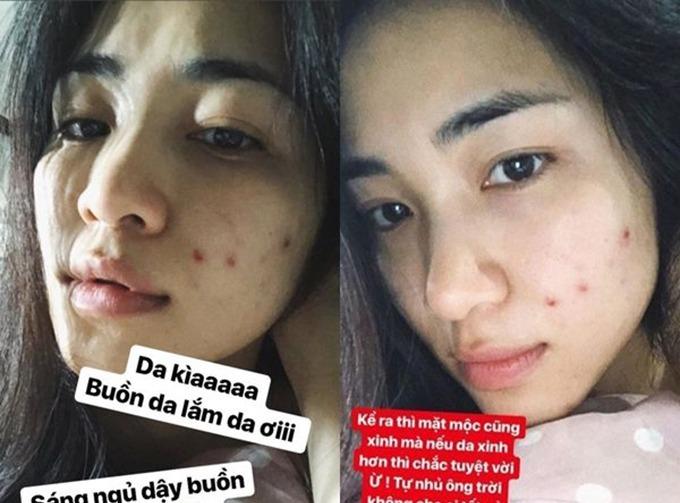 Sao Việt chăm chỉ skincare nhưng trớ trêu thay mặt vẫn đầy mụn-4