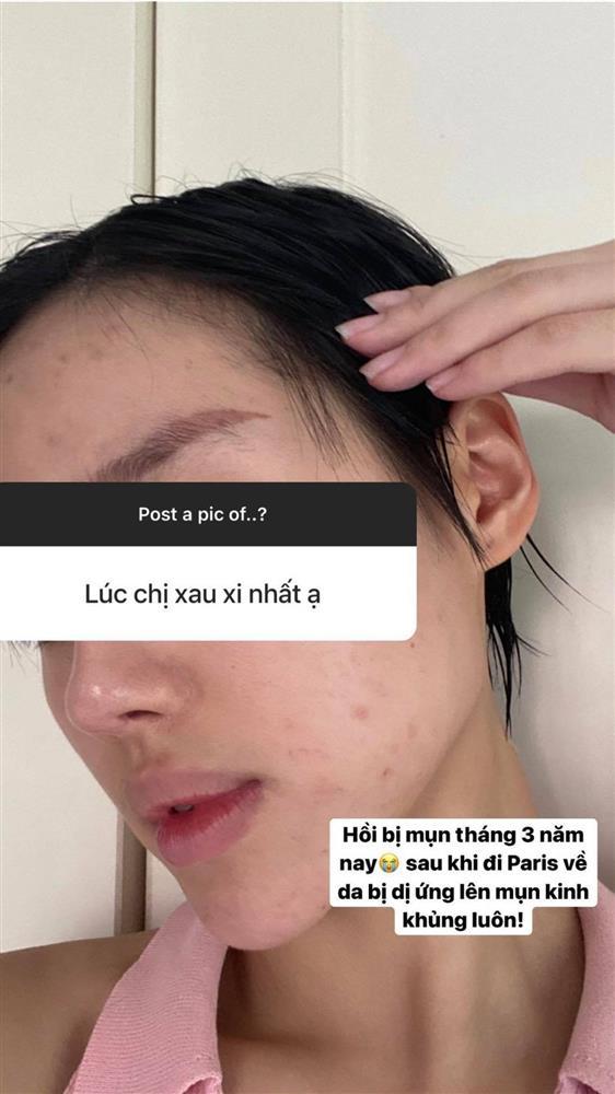 Sao Việt chăm chỉ skincare nhưng trớ trêu thay mặt vẫn đầy mụn-5