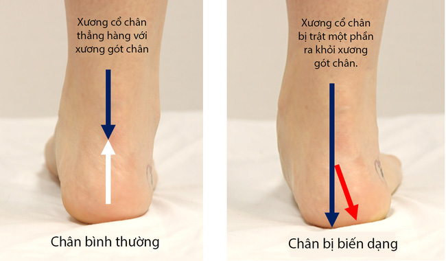 Cháu trai 4 tuổi chân bị biến dạng, bà ngoại khóc hết nước mắt vì hối hận với việc làm của mình-2
